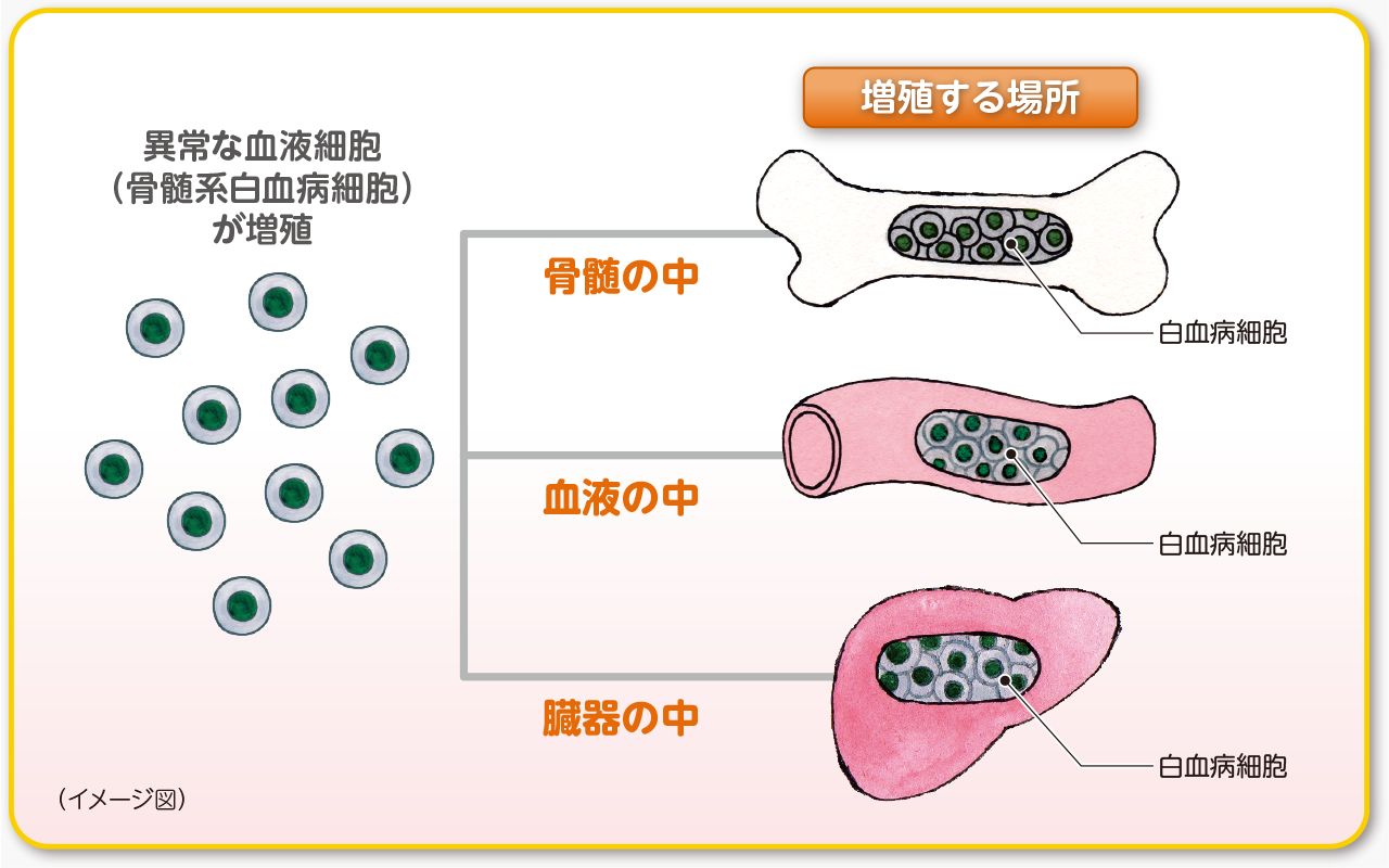 異常な血液細胞（骨髄系白血病細胞）が増殖