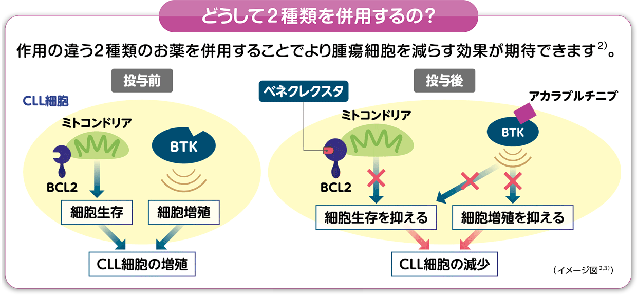 ベネクレクスタとアカラブルチニブの併用による作用イメージ図。作用の違う2種類のお薬を併用することで、よりCLL細胞を減らす効果が期待できます。